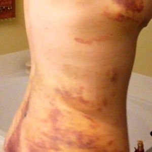 Hút mỡ xong bị đau, bầm tím và cứng bên dưới da - tôi nên làm gì?