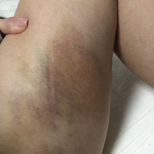 8 ngày sau hút mỡ, vết bầm bị đỏ, ngứa và đau, nhưng bác sĩ bảo vẫn bình thường.