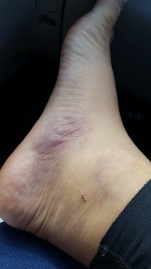 3 ngày trước tôi đã làm hút mỡ đùi trong và đầu gối – trông chân tôi có giống có cục máu đông không?