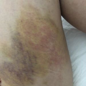 8 ngày sau hút mỡ, vết bầm bị đỏ, ngứa và đau, nhưng bác sĩ bảo vẫn bình thường.