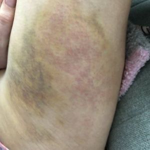 8 ngày sau hút mỡ, vết bầm bị đỏ, ngứa và đau, nhưng bác sĩ bảo vẫn bình thường.