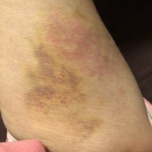 8 ngày sau hút mỡ, vết bầm bị đỏ, ngứa và đau, nhưng bác sĩ bảo vẫn bình thường.