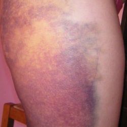 Cả hai bên đùi bị bầm tím nặng sau hút mỡ đùi 6 ngày thì có bình thường hay không?