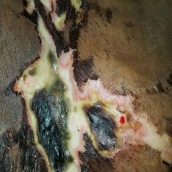 Đã hút mỡ bụng và ụ hông gần 3 tuần, vết bầm tím đang thay đổi – là bầm tím thường hay hoại tử?