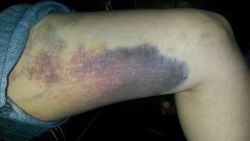 Làm cách nào để cải thiện bầm tím và cảm giác tê dại sau hút mỡ má đùi trong 1 tuần?