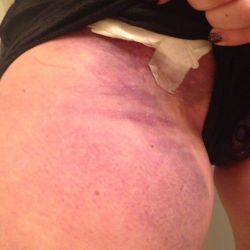 Liệu mát-xa có gây bầm tím nặng ở vùng đùi trên sau hút mỡ bụng không?