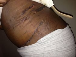 Vết bầm tím đang làm da tôi nứt toác ra – điều đó có bình thường không?