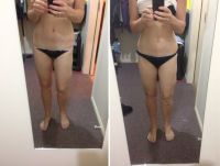 Bị ngứa sau hút mỡ 8 ngày thì có bình thường không?