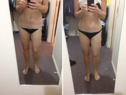 Bị ngứa sau hút mỡ 8 ngày thì có bình thường không?