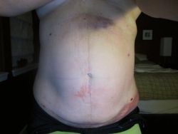 Làm thế nào để phân biệt mỡ thừa với sưng nề sau khi hút mỡ?