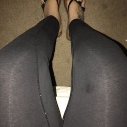 Dù chỉ hút mỡ ở má đùi trong và làm tạo hình thành bụng, nhưng bàn chân và cẳng chân lại sưng nề – như thế có bình thường không?