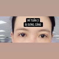 Mí cắt bị sưng sau 1 tháng