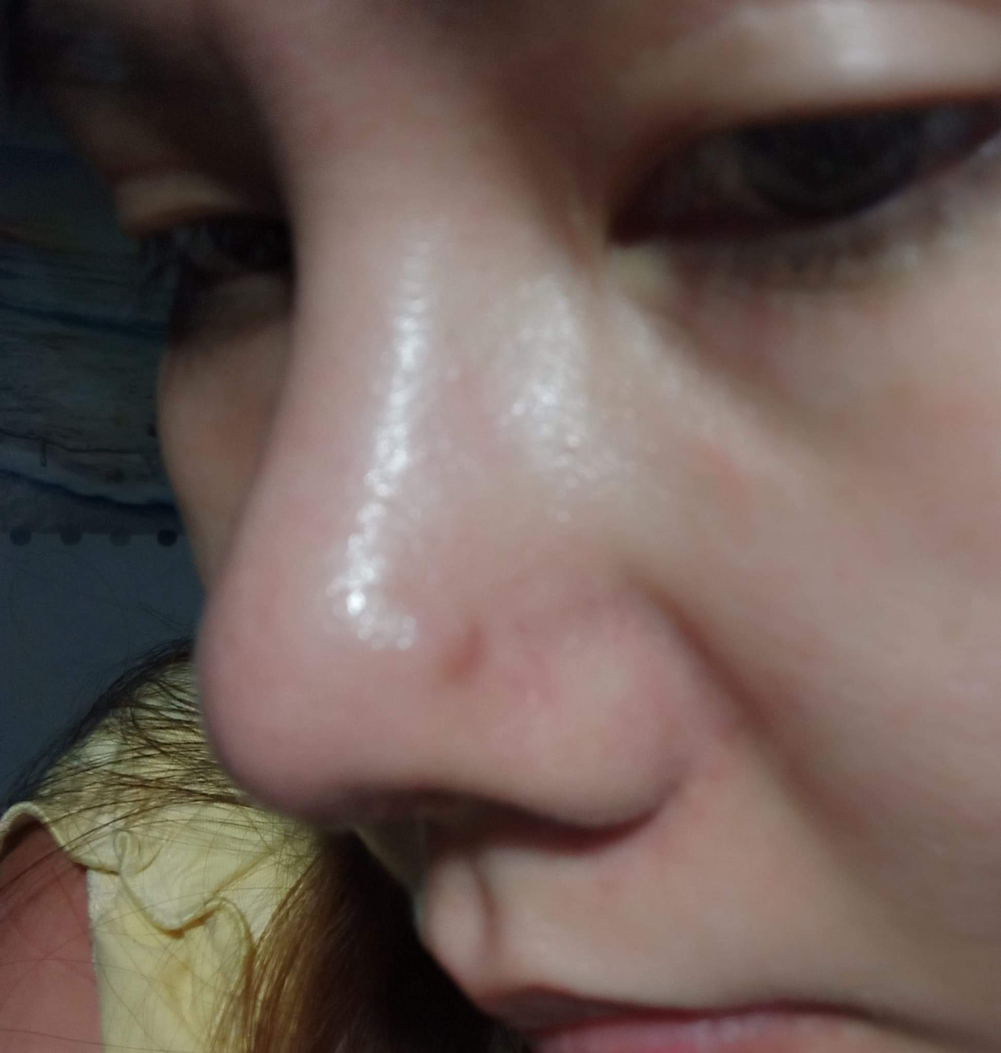 Mũi tôi bị sưng phồng bên cánh mũi phải và hơi lõm cánh mũi trái. Sau phẫu thuật 5 lần