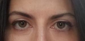 Mí mắt trên bị sụp nặng sau khi tiêm Dysport xóa nếp nhăn trán và nếp cau mày