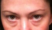 Trường hợp của tôi nên tiêm filler hay phẫu thuật cắt mí dưới?