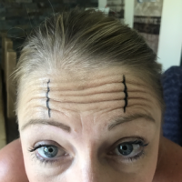 Sụp mí sau khi tiêm Dysport: liệu có chỉnh sửa được không?