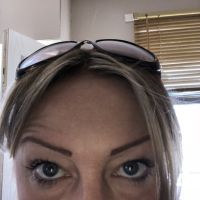 Sụp mí sau khi tiêm Dysport: liệu có chỉnh sửa được không?