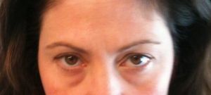 Trường hợp của tôi nên tiêm filler hay phẫu thuật cắt mí dưới?