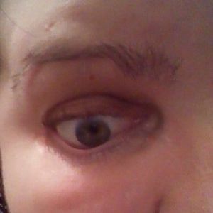 Tiêm Steroid vào mô sẹo sau cắt mí có những nguy cơ gì?