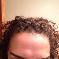 Đã 3 tháng sau khi tiêm Dysport vào trán nhưng vẫn còn cục u lớn trên trán???