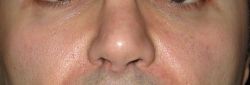 Vùng dưới mắt và má trũng sâu, đã cấy mỡ, tiêm Restylane, Radiesse nhưng không hiệu quả: Liệu có phương pháp nào khác không, hay có cần cắt mí dưới không?