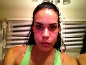 Cắt mí dưới có thể loại bỏ được tình trạng sưng phồng dưới mí này của tôi không?