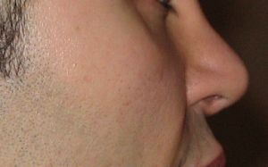 Vùng dưới mắt và má trũng sâu, đã cấy mỡ, tiêm Restylane, Radiesse nhưng không hiệu quả: Liệu có phương pháp nào khác không, hay có cần cắt mí dưới không?