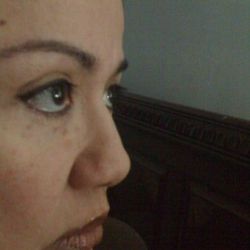 Bị lật mí nhẹ dai dẳng sau nhiều năm cắt mí dưới, có thể sửa được nữa không?