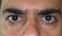 Cắt mí dưới hay tiêm filler/cấy mỡ là phù hợp nhất với tôi?