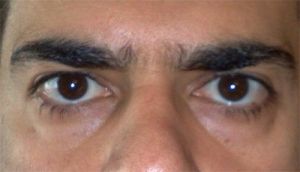 Cắt mí dưới hay tiêm filler/cấy mỡ là phù hợp nhất với tôi?