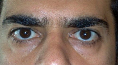 Cắt mí dưới hay tiêm filler/cấy mỡ là phù hợp nhất với tôi? Cắt mí dưới hay tiêm filler/cấy mỡ là phù hợp nhất với tôi?