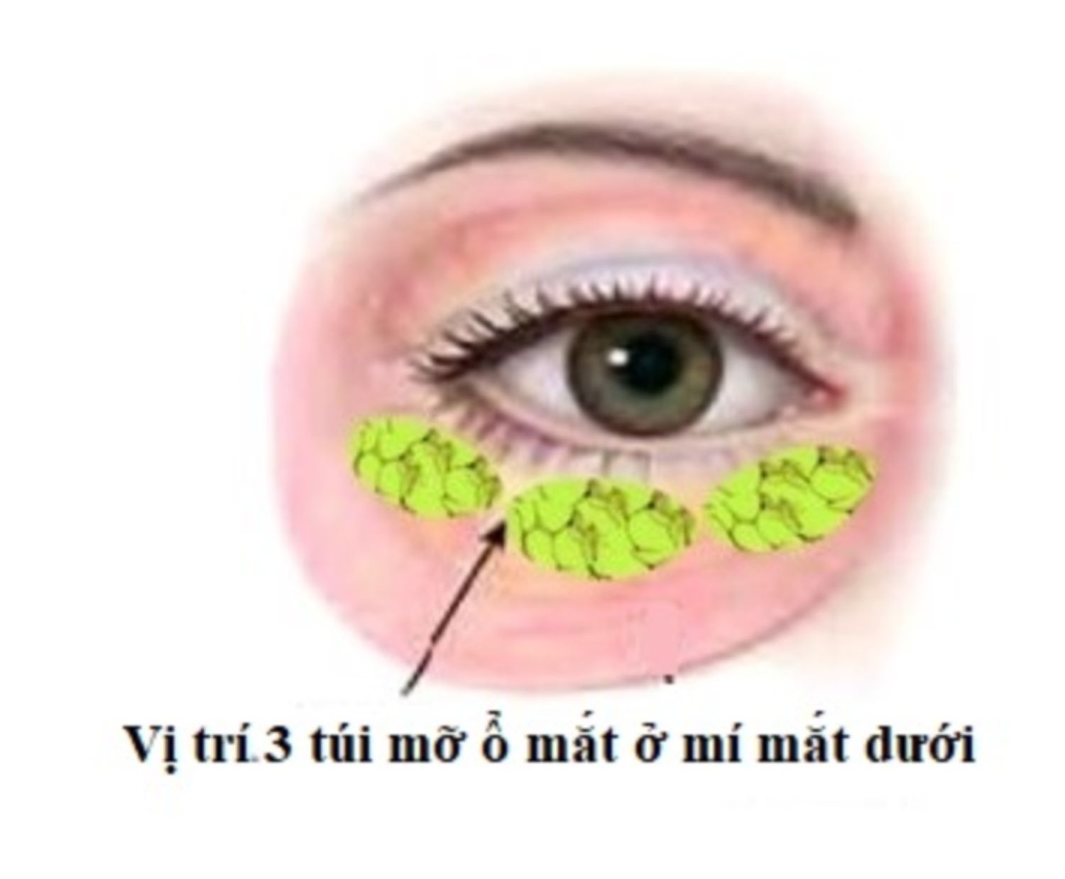 3 túi mỡ ổ mắt ở dưới mắt
