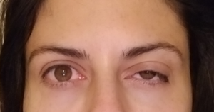 Mí mắt trên bị sụp nặng sau khi tiêm Dysport xóa nếp nhăn trán và nếp cau mày