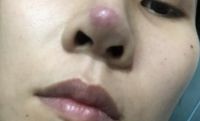 Nâng mũi bị đỏ đầu mũi ???