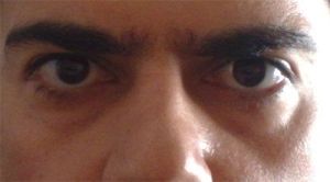 Cắt mí dưới hay tiêm filler/cấy mỡ là phù hợp nhất với tôi?