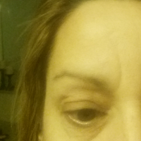 Có dịch lỏng tích tụ sau khi tiêm Dysport xóa nếp nhăn giữa hai đầu lông mày?