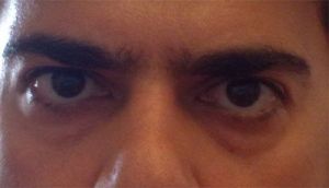 Cắt mí dưới hay tiêm filler/cấy mỡ là phù hợp nhất với tôi?