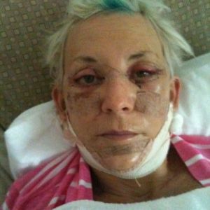 Mắt cực kỳ nhạy cảm sau khi cắt mí trên và mí dưới