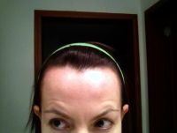 Lông mày bị kéo hếch lên và có thêm nếp nhăn mới sau khi tiêm dysport xóa nếp nhăn trán