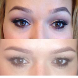 Chân mày bị sụp sau khi chỉ tiêm dysport vào cơ trán. Có chỉnh sửa được không?