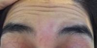 Như này có phải tôi bị dị ứng với botox không? Tôi cũng bị khó nuốt trong vòng vài giờ sau tiêm
