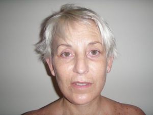 Mắt cực kỳ nhạy cảm sau khi cắt mí trên và mí dưới