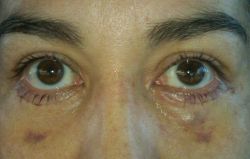 2 tuần sau phẫu thuật mí dưới: xuất hiện một vết sưng u lên ở dưới mắt, liệu có nên matxa không?