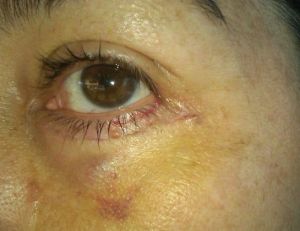 2 tuần sau phẫu thuật mí dưới: xuất hiện một vết sưng u lên ở dưới mắt, liệu có nên matxa không?