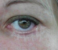 1 năm sau cắt mí dưới: sẹo xấu và co rút mí?