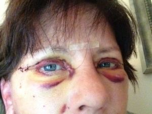 Làm sao tôi phân biệt được giữa sưng nề và nhiễm trùng sau cắt mí dưới?