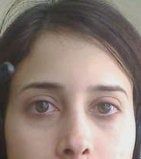 Chỉnh sửa mí mắt dưới