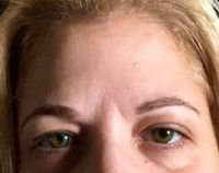 Sau khi tiêm Dysport trên trán: xuất hiện nếp cau mày ngay cả khi mặt ở trạng thái nghỉ ngơi, thư giãn?