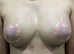 Tôi có bị thông khe sau phẫu thuật nâng ngực không?