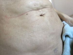 Tôi có nên lo lắng về ngấn bụng lổn nhổn ở bụng sau hút mỡ không?